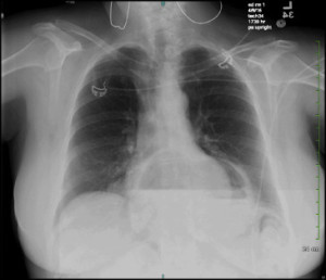 Chest radiograph with epigastric air-fluid level. The stomach has been displaced superiorly into the chest.