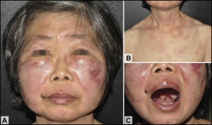 The clinical manifestations of the disease were evident. (A) The patient had symmetrical violaceous swelling on both cheeks. Deep-seated induration occurred on palpation. (B) Faint violaceous patches could be seen on her neck, upper chest, and on both arms. (C) An ulcer measuring 1.3 × 1.3 cm and covered with necrotic tissue was located on the patient's left tonsil.