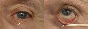 Left lower eyelid with a yellow, raised mass (left) with ulceration through the conjunctiva and tarsus (right)