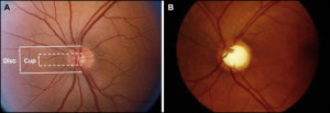 Glaucomatous excavation of the optic nerve: Loss of optic nerve tissue results in excavation or “cupping” of the optic nerve head, which is best viewed by direct ophthalmoscopy. (A) Vertical cup-to-disk (C:D) ratio within the normal range. (B) Glaucomatous cupping has an increased C:D ratio.