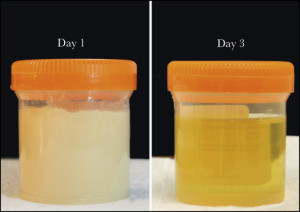 Plasma Lactescence in Acute Pancreatitis | The American Journal of ...