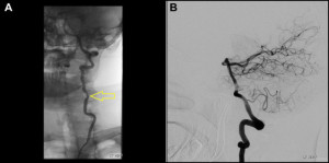 (A) Digital subtraction angiography (DSA) demonstrated focal stenosis of V2 segment of left vertebral artery (yellow arrow). (B) DSA revealed that the posterior circulation of the brain was otherwise normal beyond the level of stenosis.
