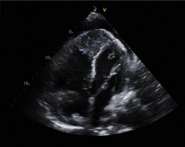 Intracardiac Metastasis as the Initial Presentation ofNon–Small Cell ...