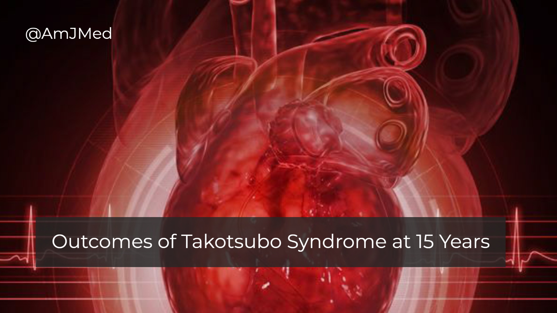 how-is-takotsubo-syndrome-different-from-a-myocardial-infarction